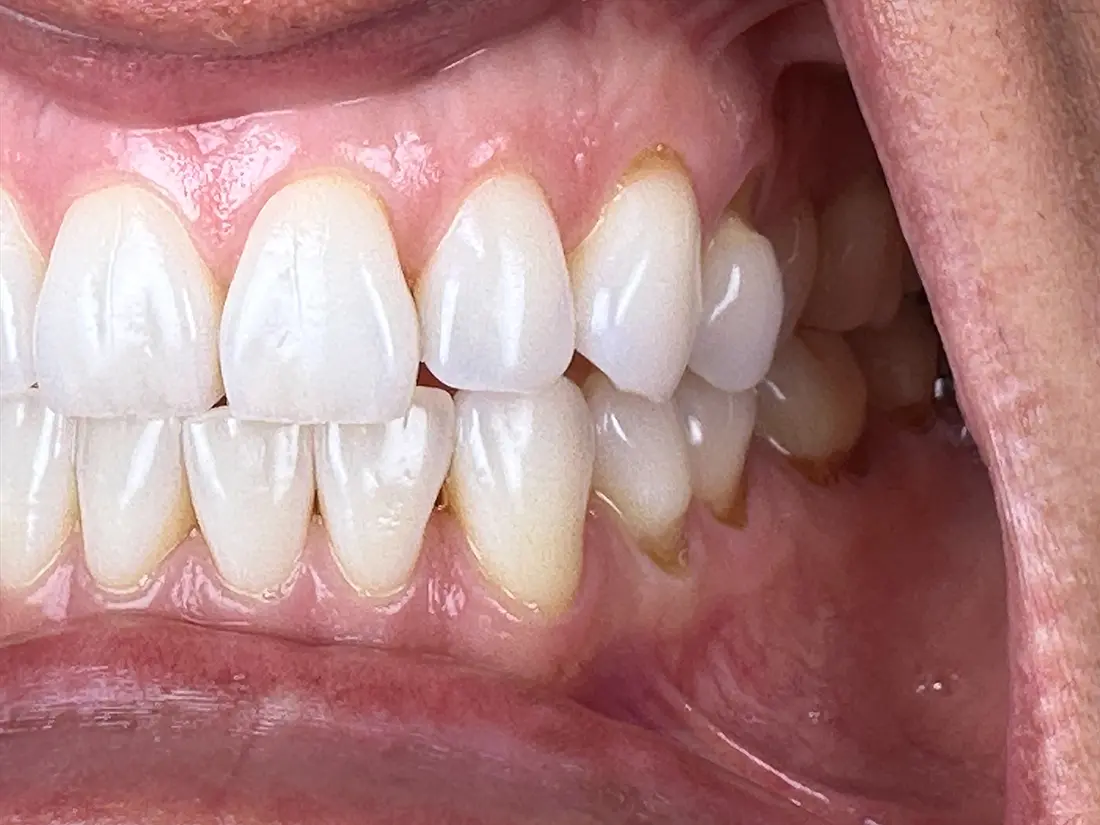 tooth clenching fix after