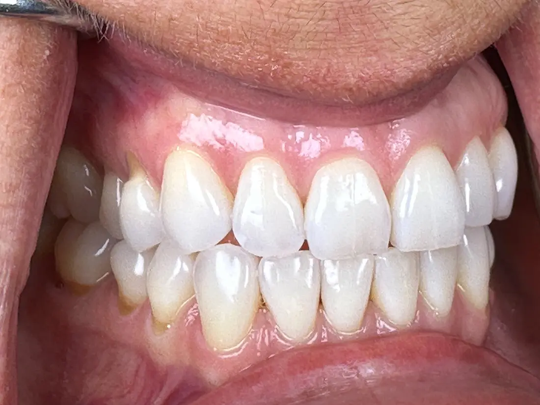 tooth clenching fix before