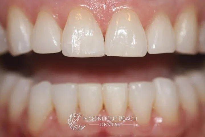 revitalized aesthetic smile after cosmetic transformation day