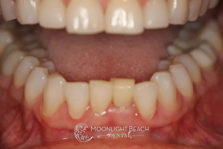 clinical smile view before cosmetic transformation day