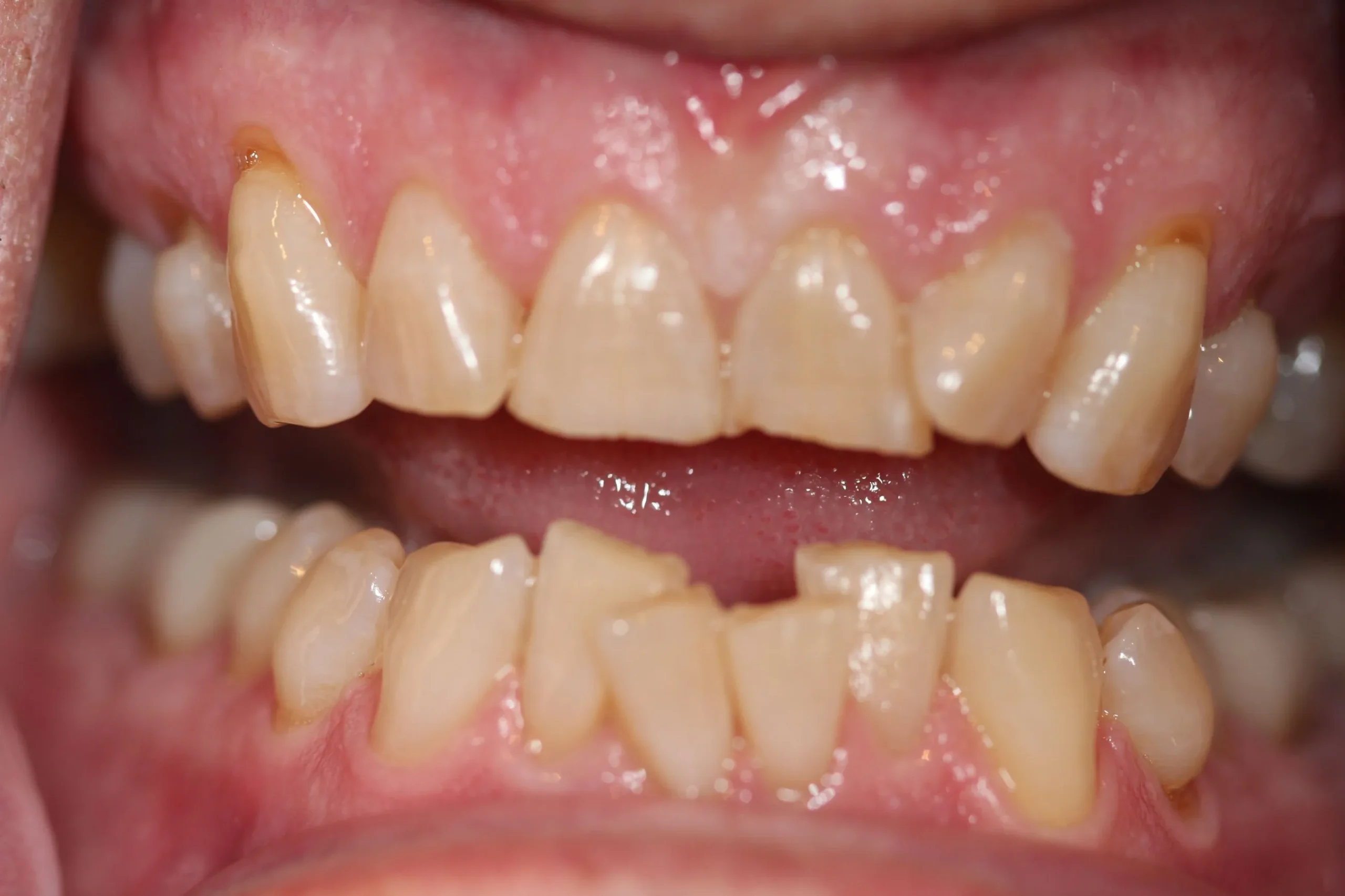 cosmetic smile makeover patient before treatment