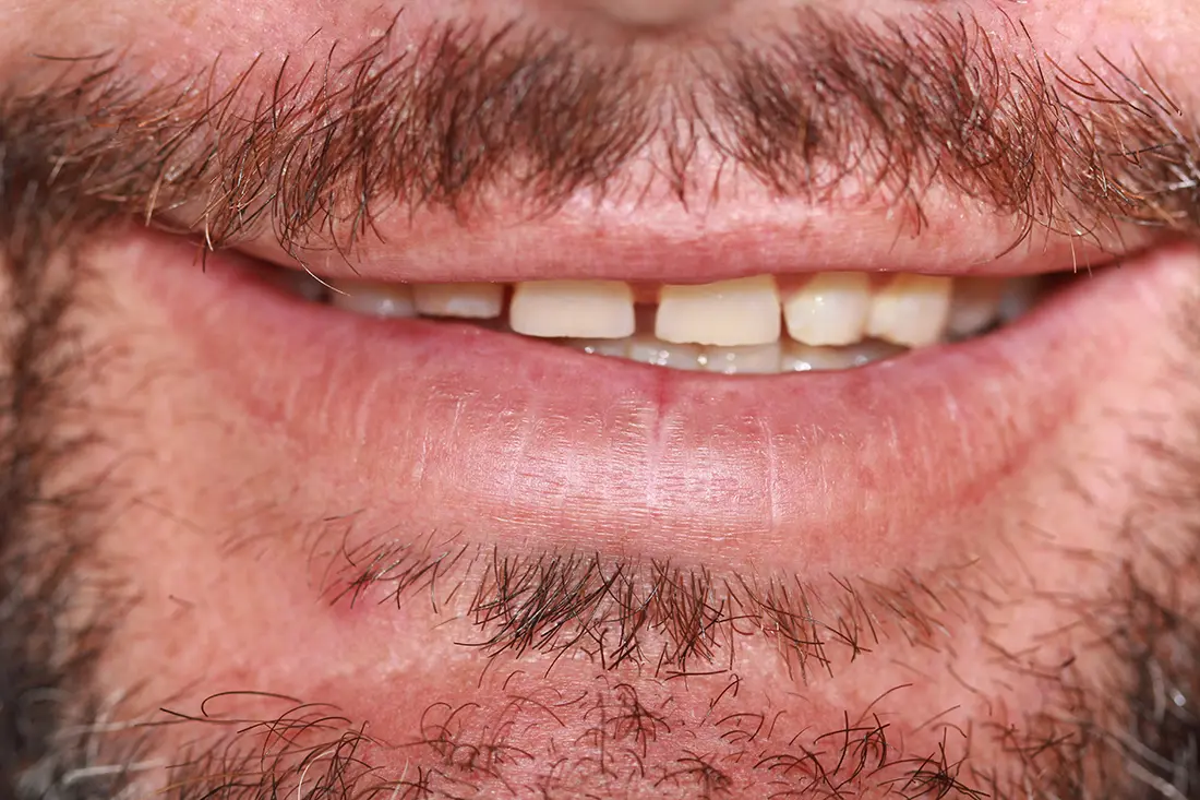 worn teeth restoration before