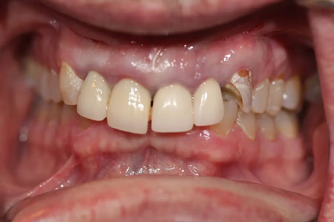 multiple missing teeth before biological zirconia implants