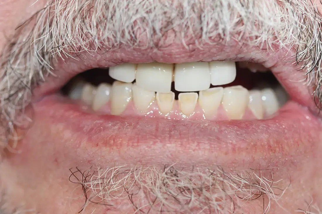 zirconia implants before
