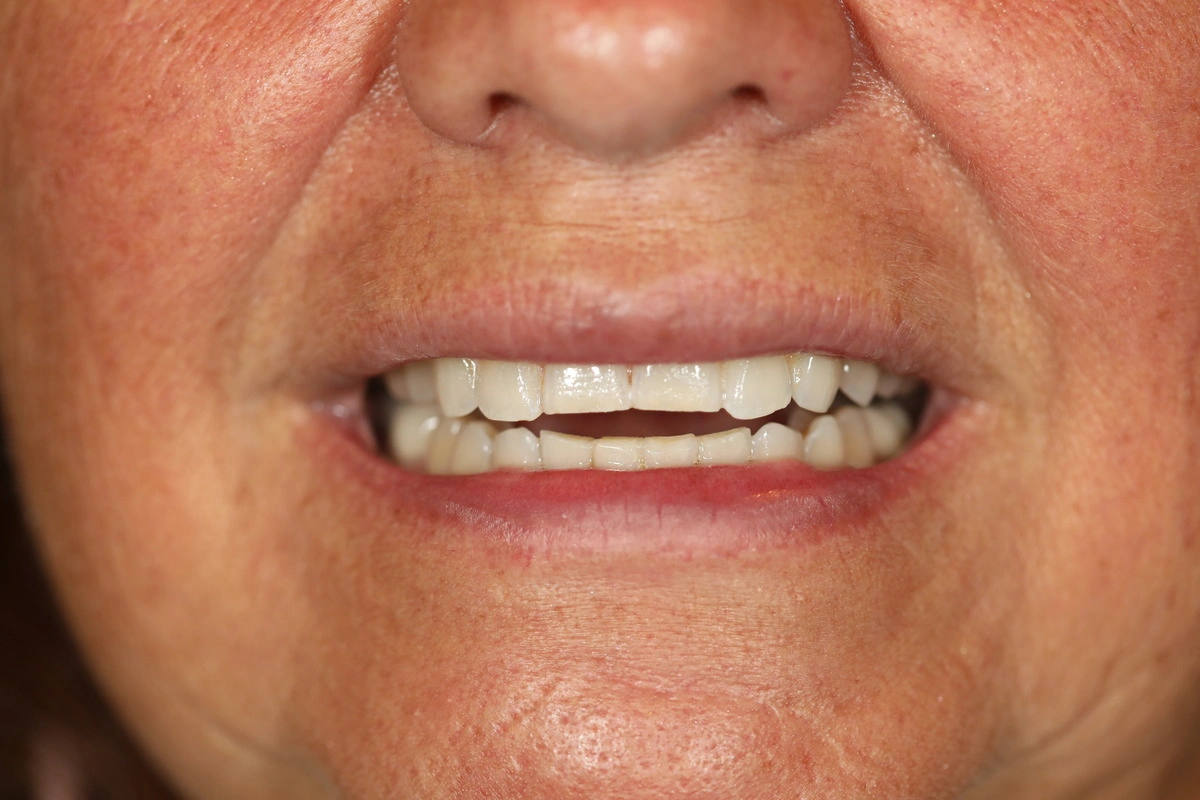 dental case study patient smile before holistic restoration